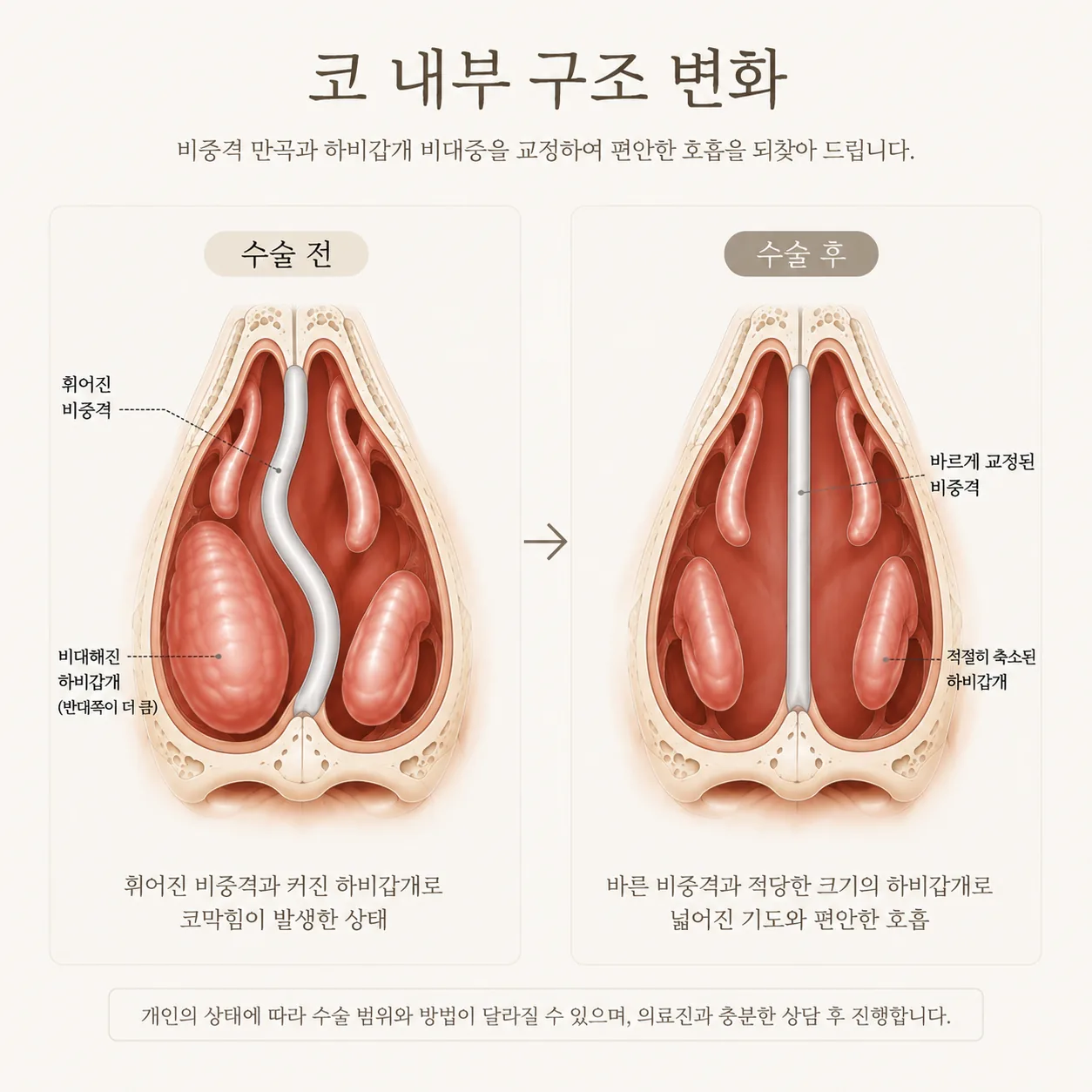 코 안쪽 구조 도해