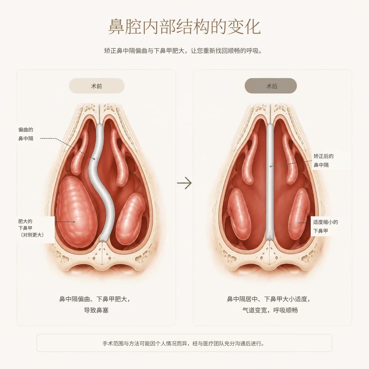 鼻腔内部结构示意图